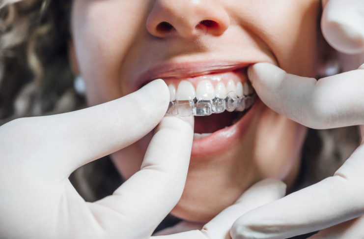Sådan får du bedst rettet dine tænder Invisalign