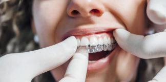 Få rettet dine skæve tænder med Invisalign Invisalign