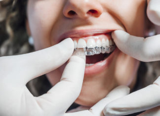 Få rettet dine skæve tænder med Invisalign Invisalign