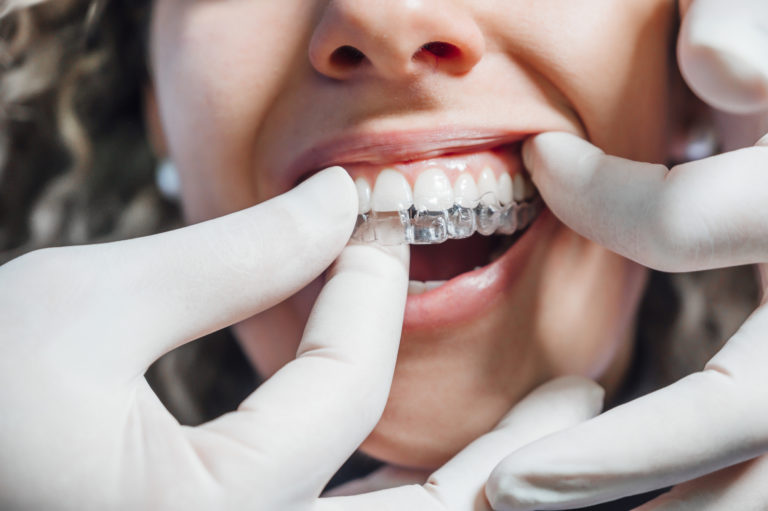 Få rettet dine skæve tænder med Invisalign